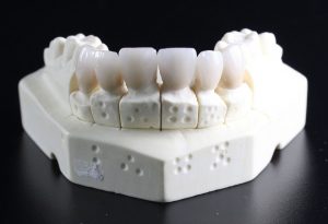 tooth-replacement-759929_960_720