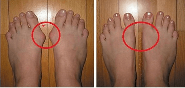 feet_bunions