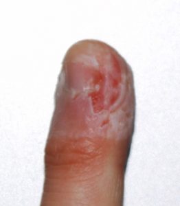 Fingerbite