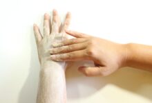peeling